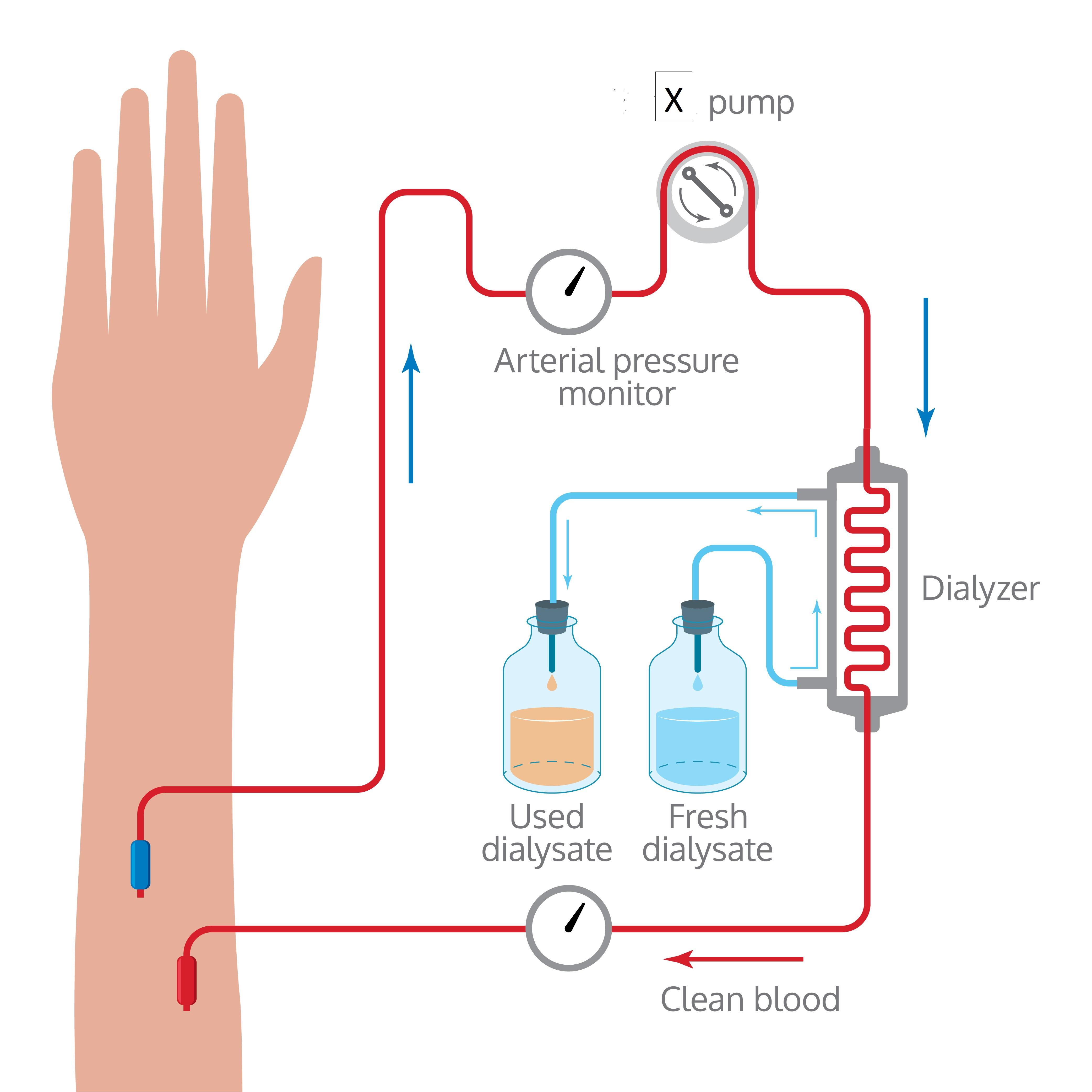 Explain the principle of dialysis with the help of a labelled diagram