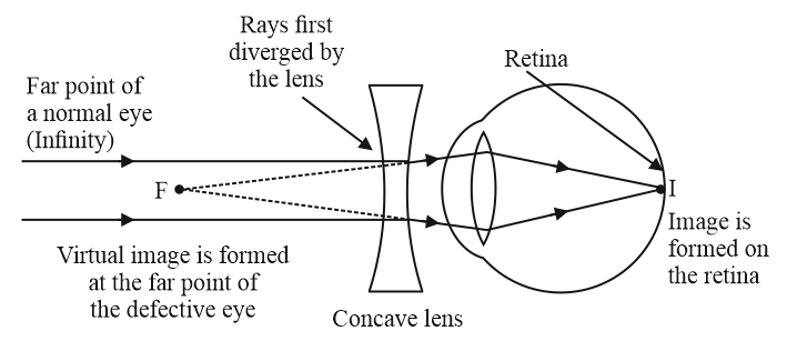 Make a ray diagram to show how the eye defect myopia is corrected by ...